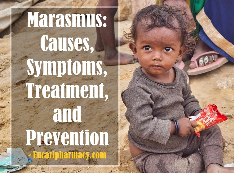 Marasmus: Causes, Symptoms, Treatment, and Prevention