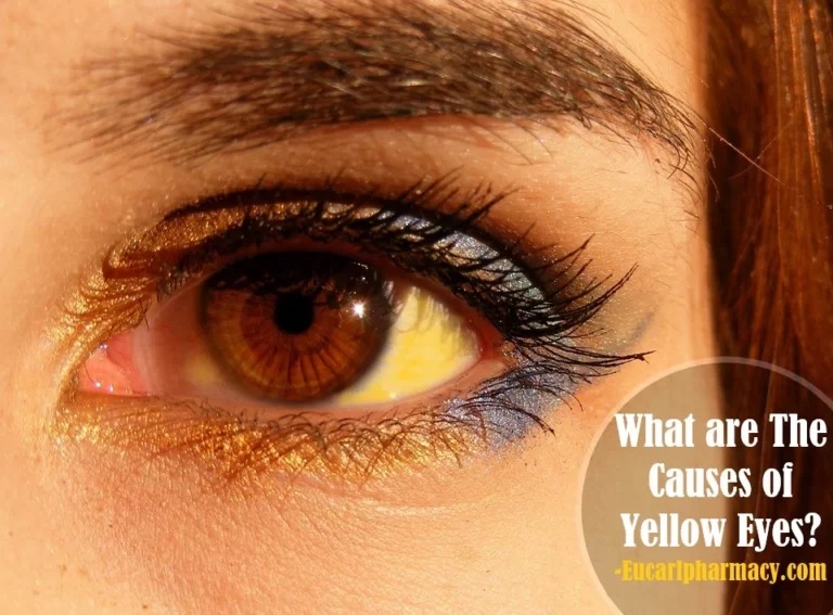 What are The Causes of Yellow Eyes?