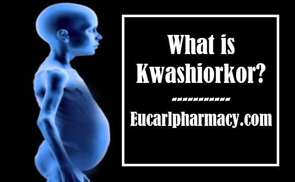 Kwashiorkor: Definition, Symptoms, Causes & Treatment